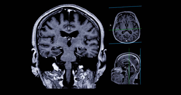 resonancia magnética cerebral axial, vista coronal y sagital con línea de referencia para detectar enfermedades cerebrales sush como enfermedad de accidente cerebrovascular, tumores cerebrales e infecciones. - mri scan brain alzheimers disease medical scan fotografías e imágenes de stock