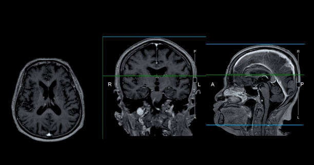 istock MRI  brain scan Axial , Coronal and sagittal view with referance line for detect  Brain  diseases sush as stroke disease, Brain tumors and Infections. 1667673875