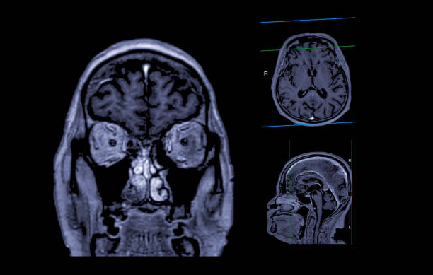 istock MRI  brain scan Axial , Coronal and sagittal view with referance line for detect  Brain  diseases sush as stroke disease, Brain tumors and Infections. 1667674002