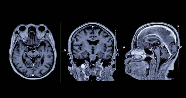 resonancia magnética cerebral axial, vista coronal y sagital con línea de referencia para detectar enfermedades cerebrales sush como enfermedad de accidente cerebrovascular, tumores cerebrales e infecciones. - mri scan brain alzheimers disease medical scan fotografías e imágenes de stock