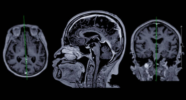 resonancia magnética cerebral axial, vista coronal y sagital con línea de referencia para detectar enfermedades cerebrales sush como enfermedad de accidente cerebrovascular, tumores cerebrales e infecciones. - mri scan brain alzheimers disease medical scan fotografías e imágenes de stock