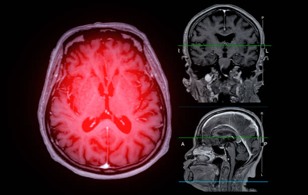 mri脳スキャン軸方向、冠状および矢状図は、脳卒中疾患、脳腫瘍および感染症として検出するための参照線を有する。 - brain mri scan alzheimers disease medical scan ストックフォトと画像
