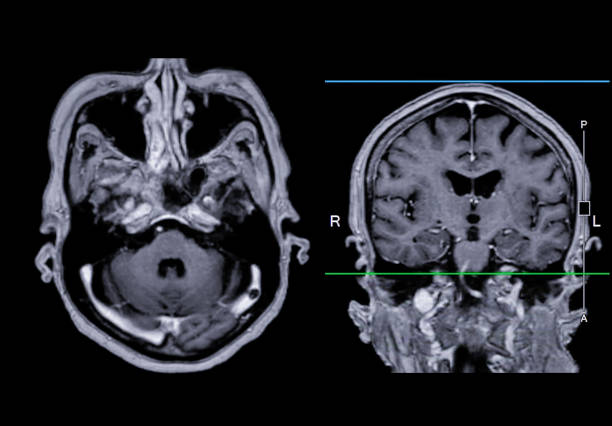 resonancia magnética cerebral vista axial y coronal con línea de referencia para detectar enfermedades cerebrales sush como enfermedad por accidente cerebrovascular, tumores cerebrales e infecciones. - mri scan brain alzheimers disease medical scan fotografías e imágenes de stock