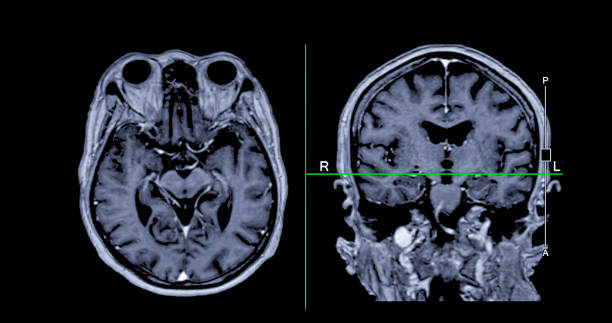 resonancia magnética cerebral vista axial y coronal con línea de referencia para detectar enfermedades cerebrales sush como enfermedad por accidente cerebrovascular, tumores cerebrales e infecciones. - mri scan brain alzheimers disease medical scan fotografías e imágenes de stock