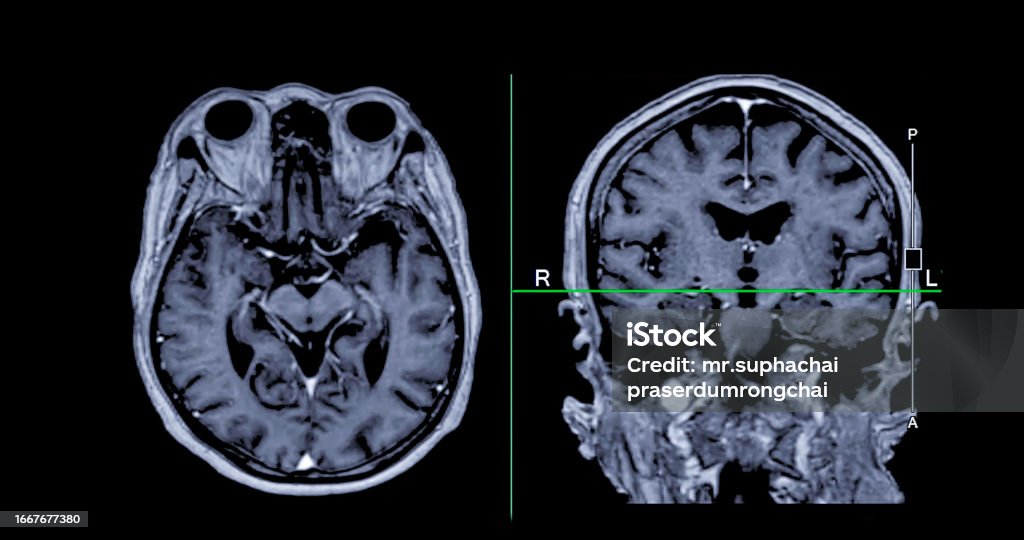 Brain Scan Views Mri Brain Scan Axial And Coronal View With Reference Line For Detect ...