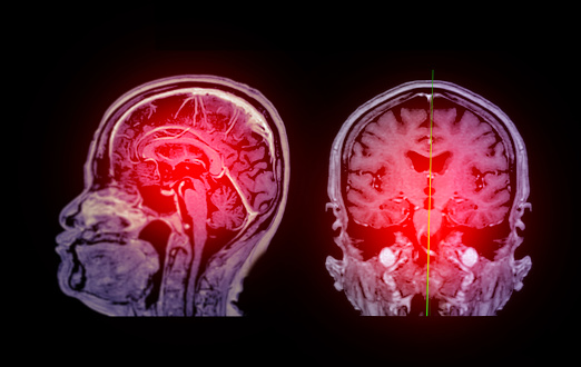 MRI  brain scan Sagittal and coronal view with reference line for detect  Brain  diseases sush as stroke disease, Brain tumors and Infections.