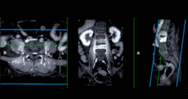 istock MRI L-S spine or lumbar spine sagittal T2 technique for diagnosis spinal cord compression. 1667682612