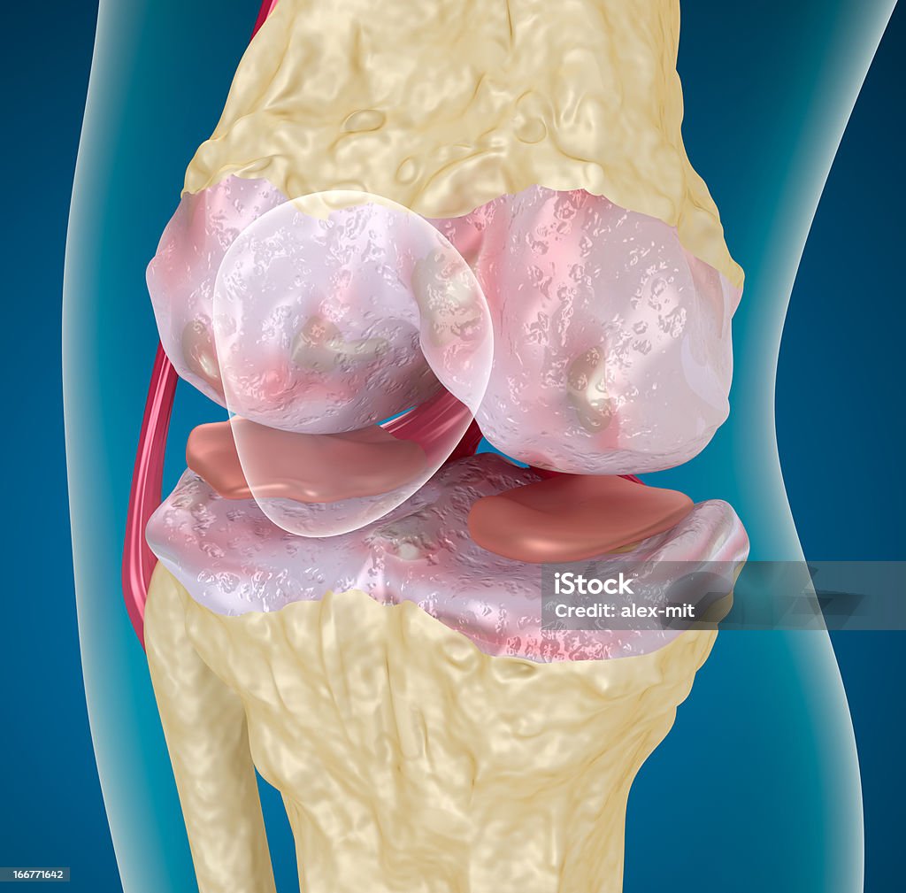 골관절염: 무릎 - 로열티 프리 골관절염 스톡 사진