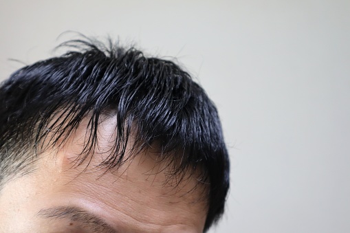 Close-up photo of a man with thinning hair