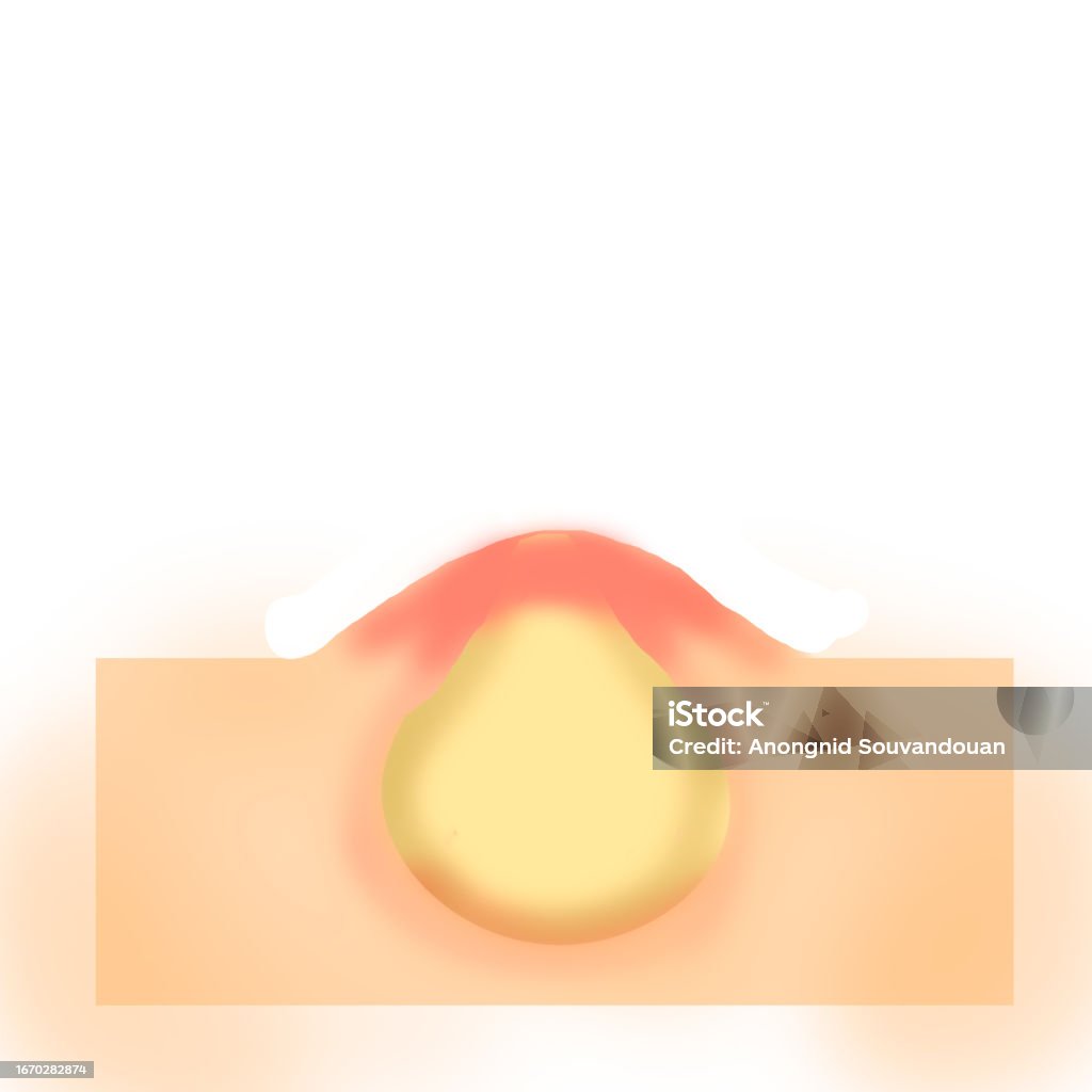 Acne Scratch Acne Vector Stock Illustration - Download Image Now - Acne, Beauty ...