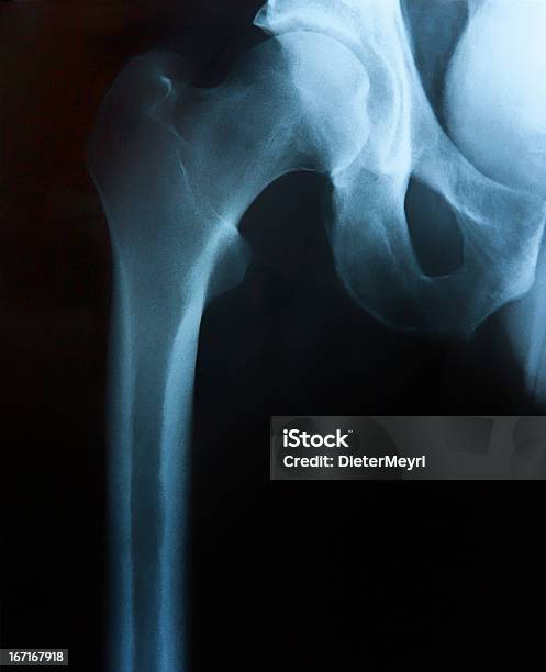 X 線 - 壊れたのストックフォトや画像を多数ご用意 - 壊れた, 腰, 骨折