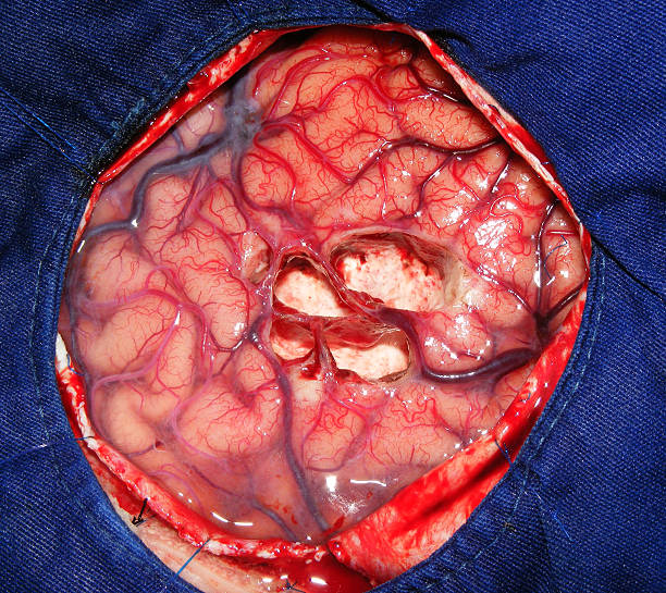 gehirnchirurgie - epilepsy healthcare and medicine surgery sulcus stock-fotos und bilder