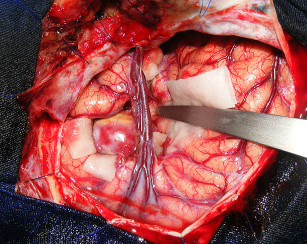 istock Aneurysm surgery in the brain 167232607