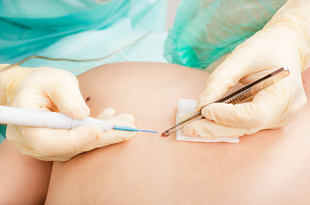 mol la extracción - dermatología fotografías e imágenes de stock