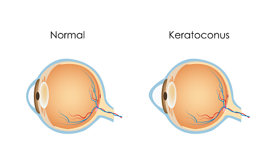 Keratoconus, eye disease, Flat vector illustration medicine