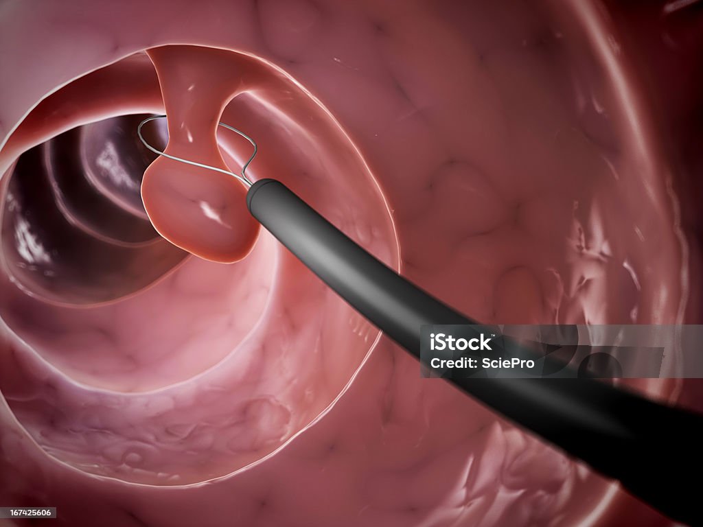 polyp removal 3d rendered illustration of a polyp removal Polyp Stock Photo