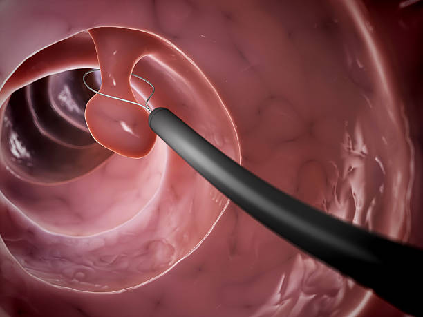 polyp removal 3d rendered illustration of a polyp removal colorectal cancer photos stock pictures, royalty-free photos & images