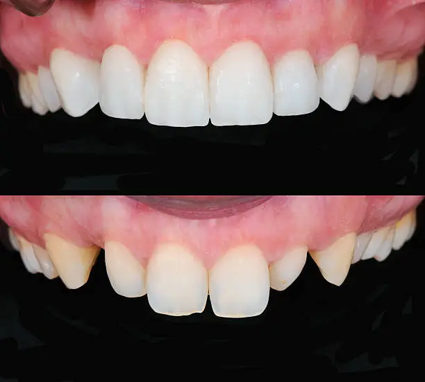 Before and after smile design dental procedure.