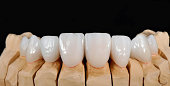 dental-veneers.jpg?b=1&s=170x170&k=20&c=