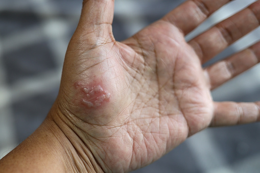 A black woman with the shingles blister on her hand