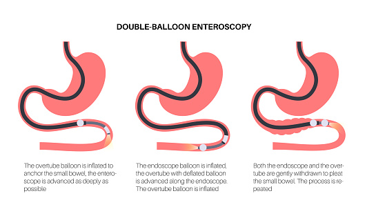 Double balloon enteroscopy minimally invasive procedure. Visualization of the small intestine. Biopsy, polyp removal, bleeding therapy, stent placement in gastrointestinal tract 
vector illustration