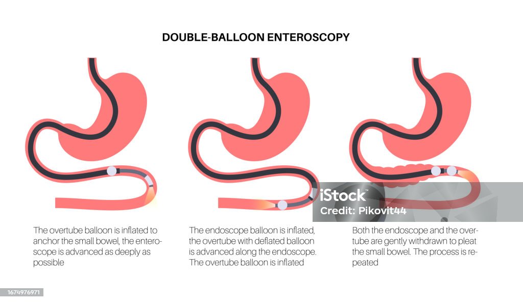 Large Intesting Balloon Double Balloon Enteroscopy Stock Illustration - Download Image Now ...