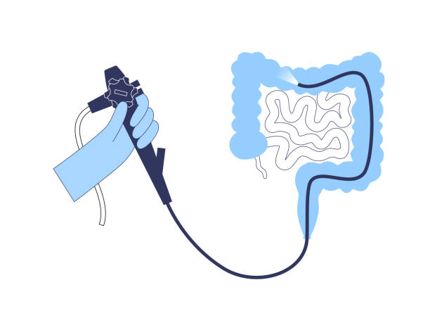 Colonoscopy medical procedure Colonoscopy is a minimally invasive procedure. Examination and treatment of the large intestine. Disorder of the colon, polyps, inflammation or swelling of bowel. Gastrointestinal disorder flat vector colonoscopy stock illustrations