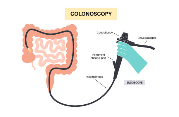 Colonoscopy medical procedure Colonoscopy is a minimally invasive procedure. Examination and treatment of the large intestine. Disorder of the colon, polyps, inflammation or swelling of bowel. Gastrointestinal disorder flat vector colonoscopy stock illustrations