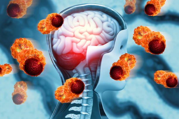 istock Cancer cells attacking a human brain. 3d illustration 1678175035