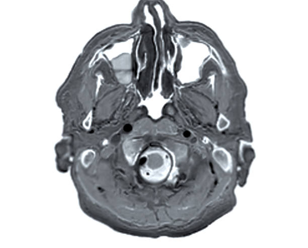 mri  brain scan  axial view for detect  brain  diseases sush as stroke disease, brain tumors and infections. - brain mri scan alzheimers disease medical scan imagens e fotografias de stock