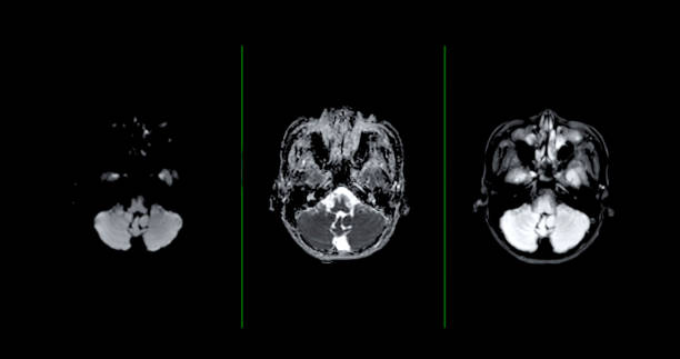 istock MRI  brain scan  axial Diffusion technique  for detect  Brain  diseases sush as stroke disease, Brain tumors and Infections. 1678265315