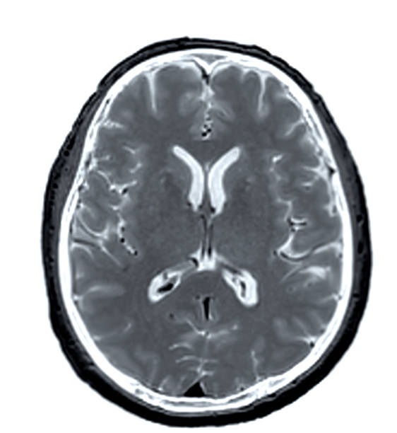 mri  brain scan  axial view for detect  brain  diseases sush as stroke disease, brain tumors and infections. - brain mri scan alzheimers disease medical scan imagens e fotografias de stock