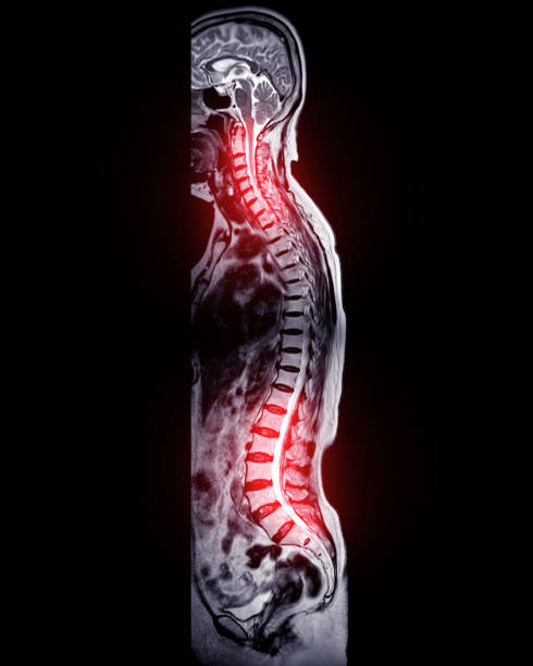 istock MRI whole spine screening for diagnosis spinal cord compression. 1678270011