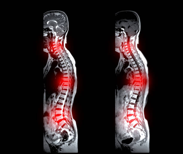 istock MRI whole spine screening for diagnosis spinal cord compression. 1678271161