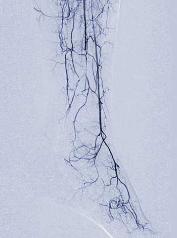 Foot angiogram or Plantar angiogram angiogram showing  Plantar and Tarsal  Artery at foot area.