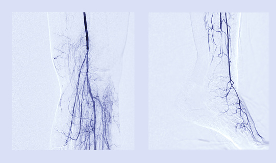 Foot angiogram or Plantar angiogram angiogram showing  Plantar and Tarsal  Artery at foot area.