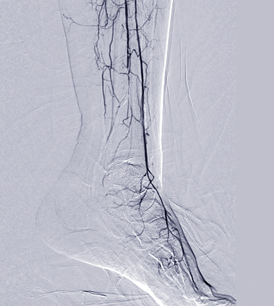 Foot angiogram or Plantar angiogram angiogram showing  Plantar and Tarsal  Artery at foot area.