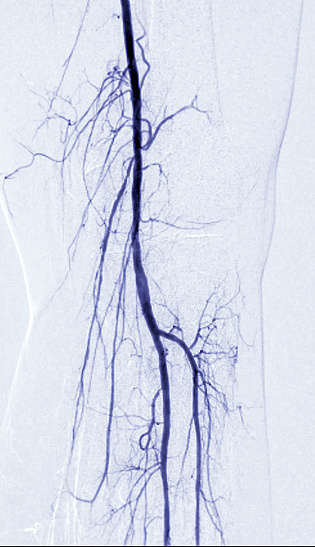 Femoral artery angiogram or angiography  at knee area.