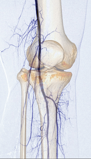Femoral artery angiogram or angiography  at knee area.
