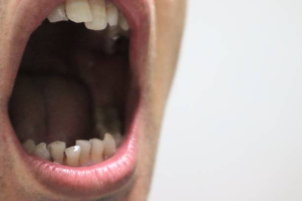 istock Close-up of a person with misaligned teeth 1680991210