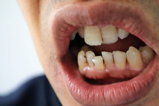 istock Close-up of a person with misaligned teeth 1681029972