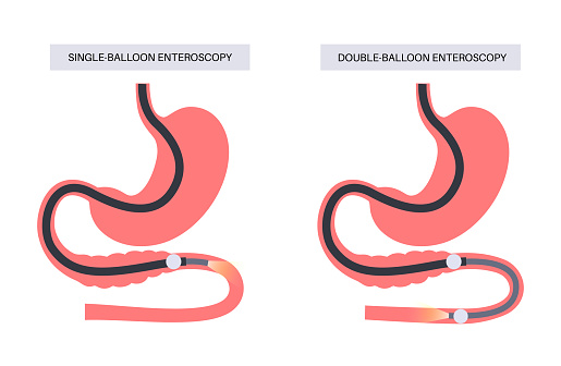 Double and single balloon enteroscopy minimally invasive procedure. Visualization of the small intestine. Biopsy, polyp removal, bleeding therapy or stent placement in gastrointestinal tract 
poster