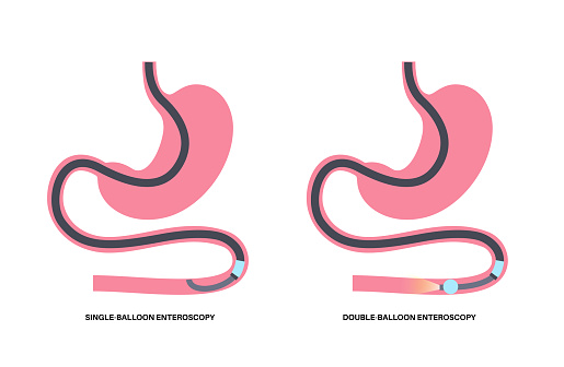 Double and single balloon enteroscopy minimally invasive procedure. Visualization of the small intestine. Biopsy, polyp removal, bleeding therapy or stent placement in gastrointestinal tract 
poster