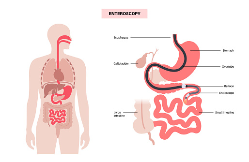 Balloon assisted enteroscopy. Visualization of the small intestine nonsurgical procedure. Gastrointestinal tract exam. Biopsy, polyp removal, bleeding therapy or stent placement vector illustration