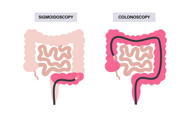 Colonoscopy and sigmoidoscopy Colonoscopy and sigmoidoscopy test. Examination and treatment of the large intestine. Disorder of the colon, inflammatory bowel disease, constipation or incontinence. Gastrointestinal medical vector colonoscopy stock illustrations