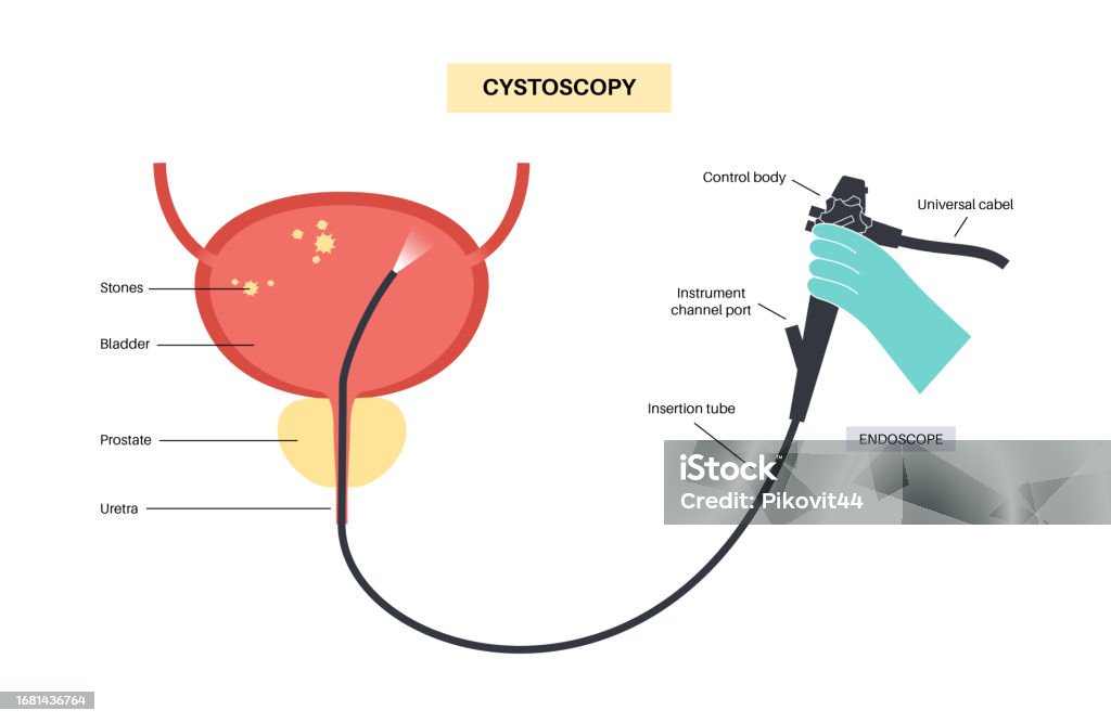 Cystoscope Lib Python Cystoscopy Examination Concept Stock Illustration - Download Image Now ...