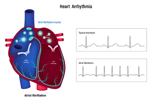Heart arrhythmia vector. Cardiac Arrhythmia. Atrial fibrillation. An irregular heartbeat.