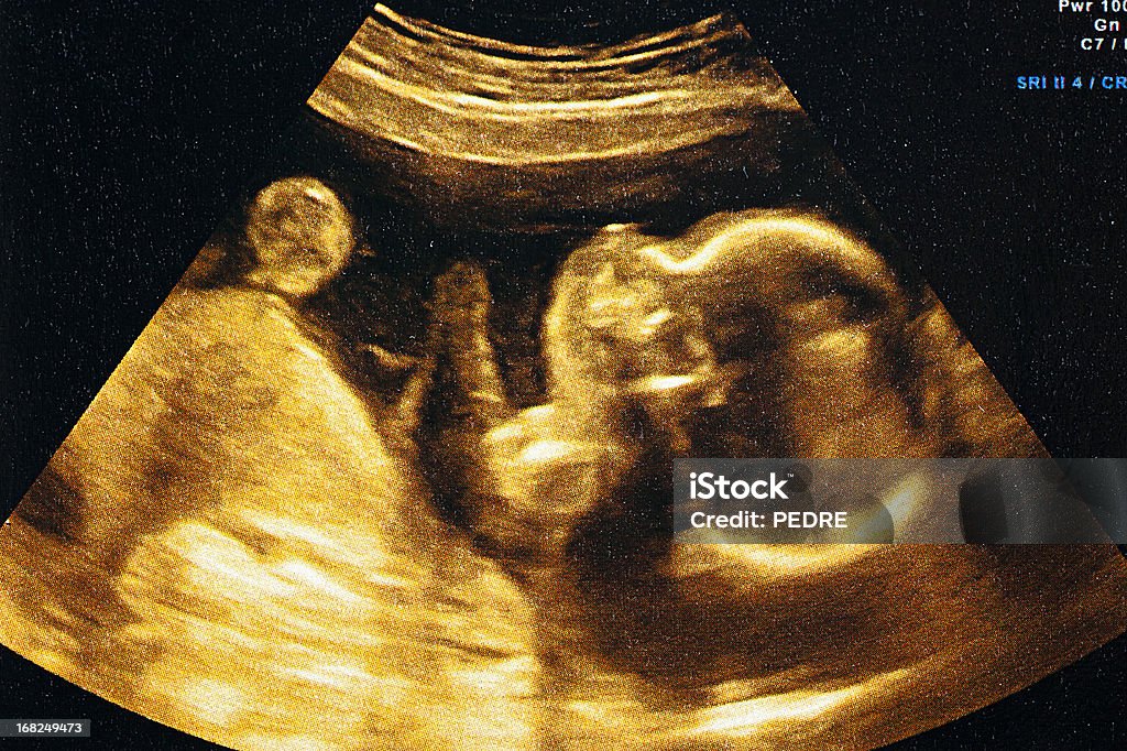 Ultrasound of a woman's fetus at 37 weeks Fetus ultrasound at 24 weeks Ultrasound Stock Photo