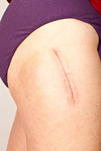 cicatriz cirugía de cadera artificial - scar fotografías e imágenes de stock