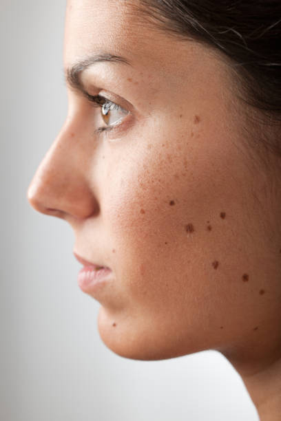 portrait d'une femme avec du mélanome malin grains de beauté, les taches de rousseur (xxxl - taupe photos et images de collection